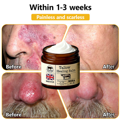 HARTEE® Tallow Healing Balm🐄（GMP Facility • FDA-Registered • Dermatologist Tested👨‍⚕️）Soothe eczema, psoriasis & rosacea—without steroids.🐄