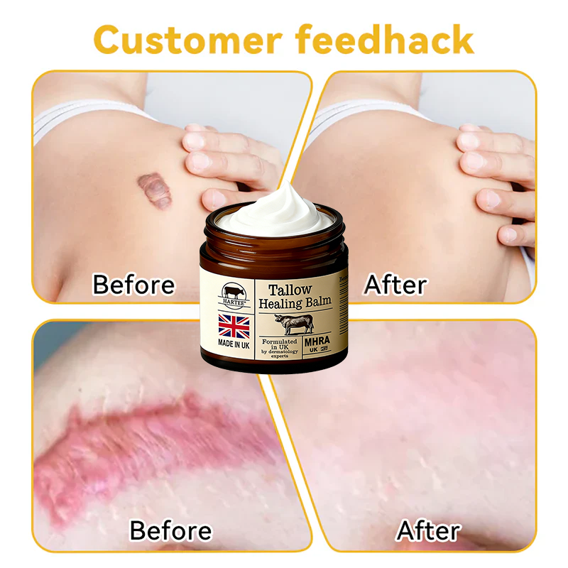 HARTEE® Tallow Healing Balm🐄（GMP Facility • FDA-Registered • Dermatologist Tested👨‍⚕️）Soothe eczema, psoriasis & rosacea—without steroids.🐄