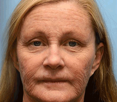 🧑‍⚕️Botox Bee Venom Wrinkle Removal Cream- LAST DAY 70% OFF🔥